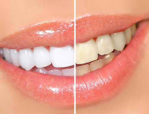 3 verdades sobre clareamento dental que você precisa saber