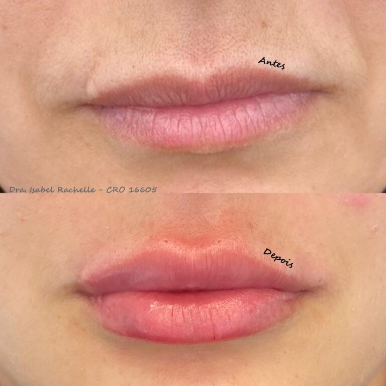 preenchimento labial