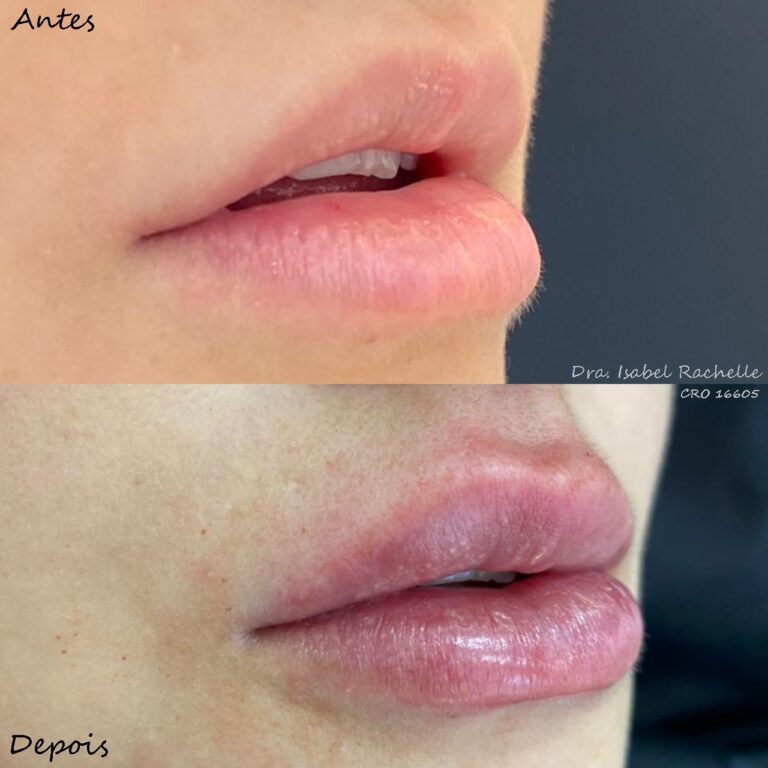 preenchimento labial