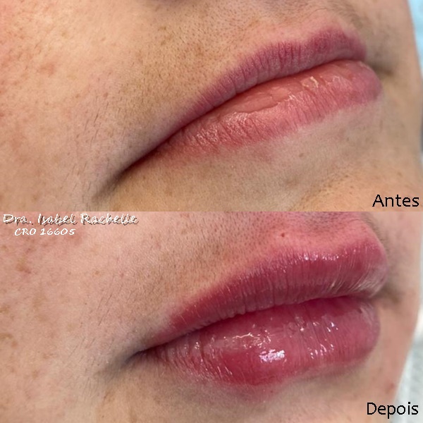 preenchimento labial