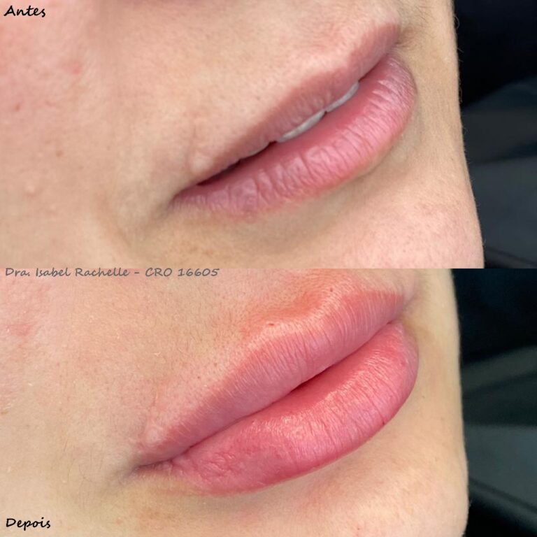 preenchimento labial